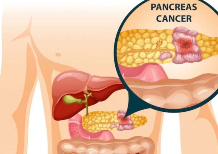 Don’t Forget To Ignore Inflammation In The Pancreas, Know Its Symptoms And Prevention In Time